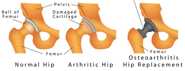 Diagram of a hip.