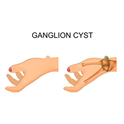 Ganglion cyst diagram.