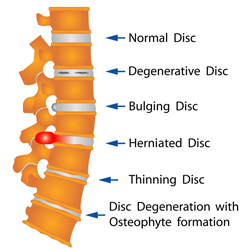 diagram of a herniated disk.