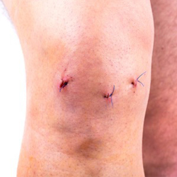 photo of knee with stitches post-surgery.