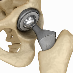 diagram of hip replacement technology.