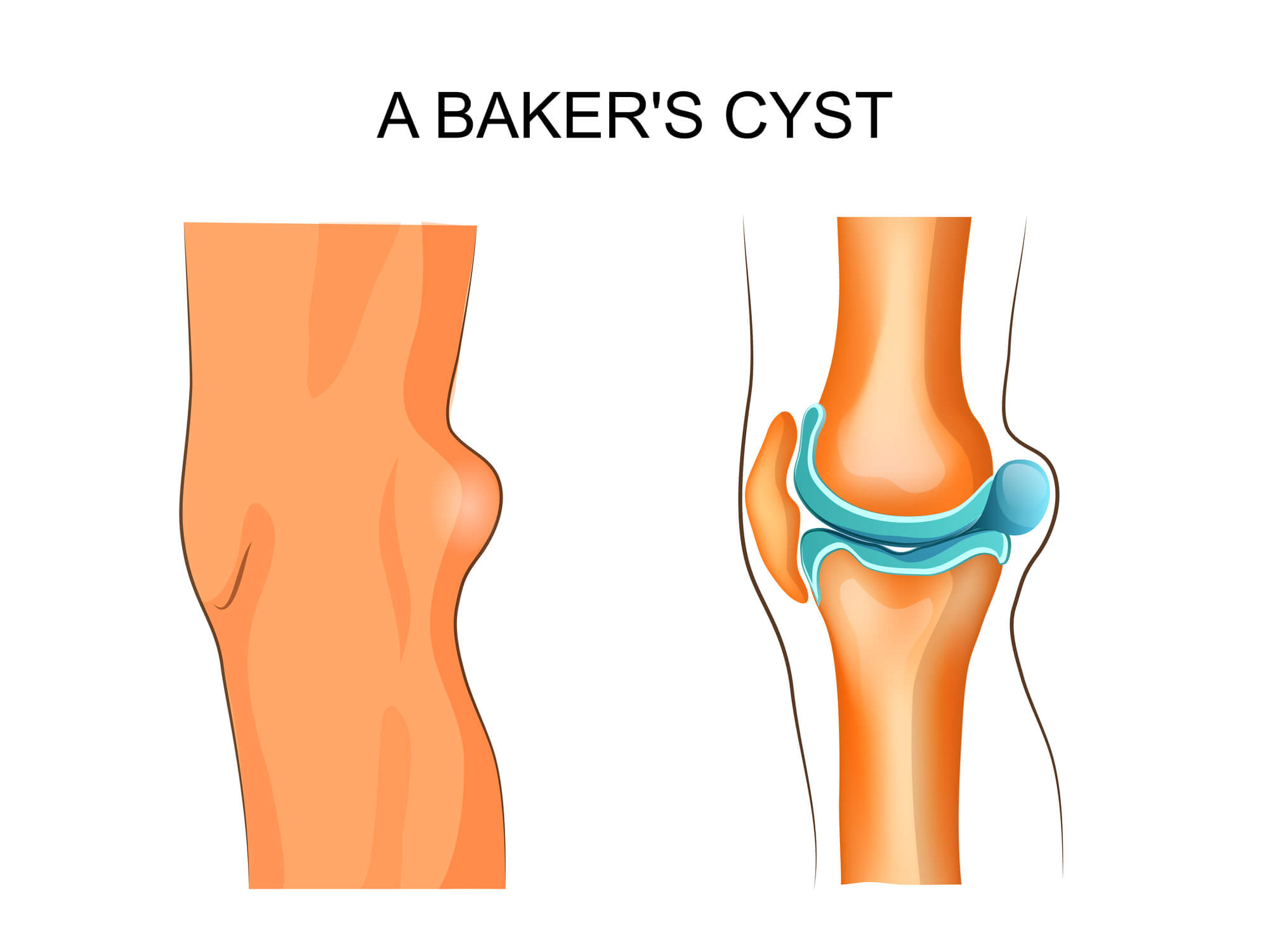 Illustration of knee with Baker's cyst.