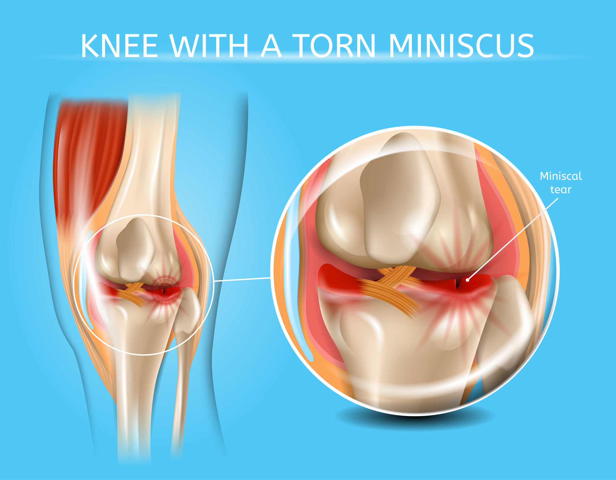 Illustration of knee with torn meniscus.