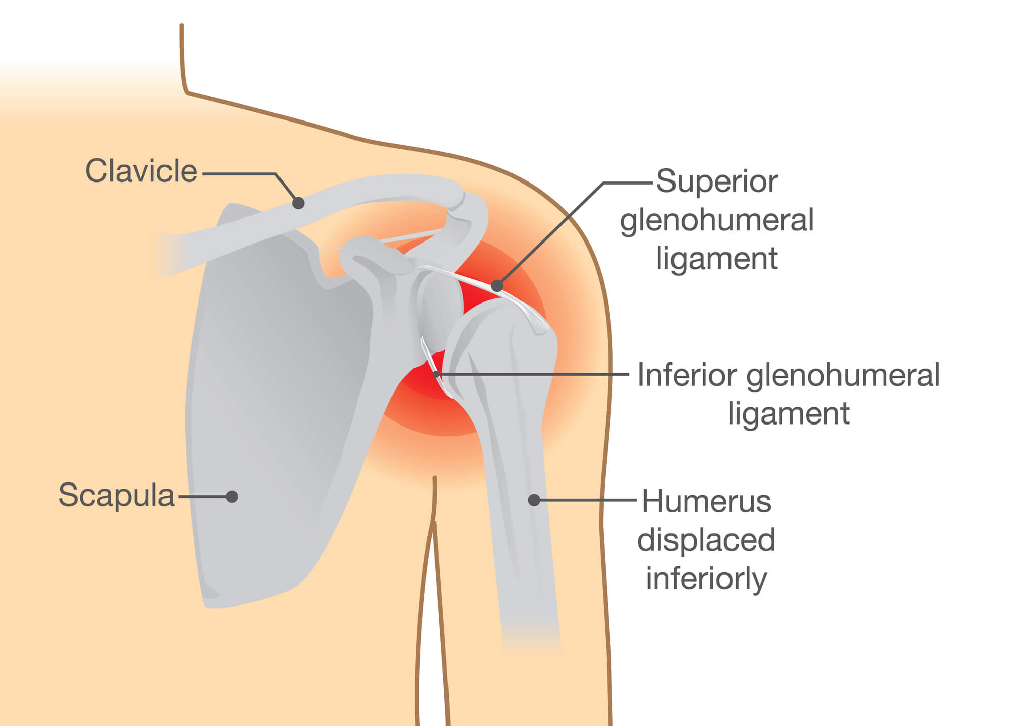 Illustration of dislocated shoulder.