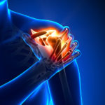 Illustration of body that highlights the shoulder.