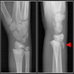 X-ray of growth plate fracture.