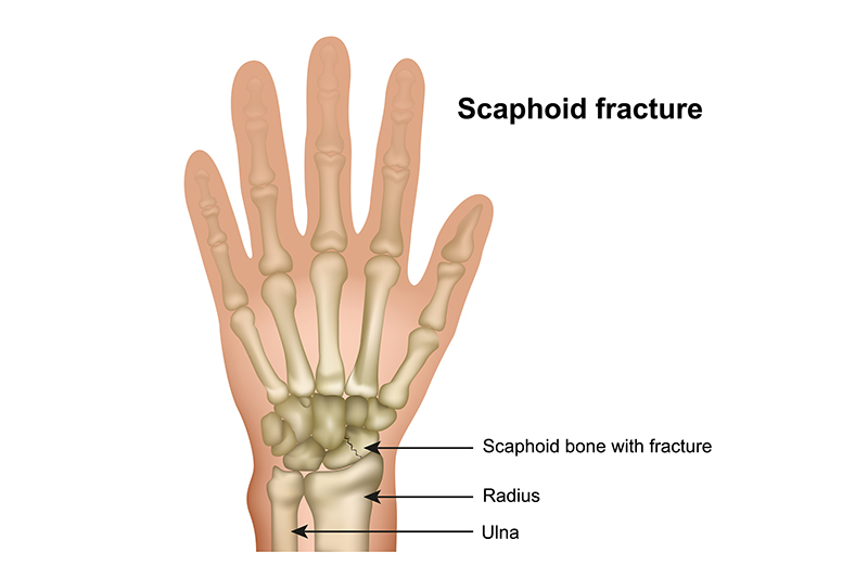 Bones of open hand showing scaphoid bone location and fracture.