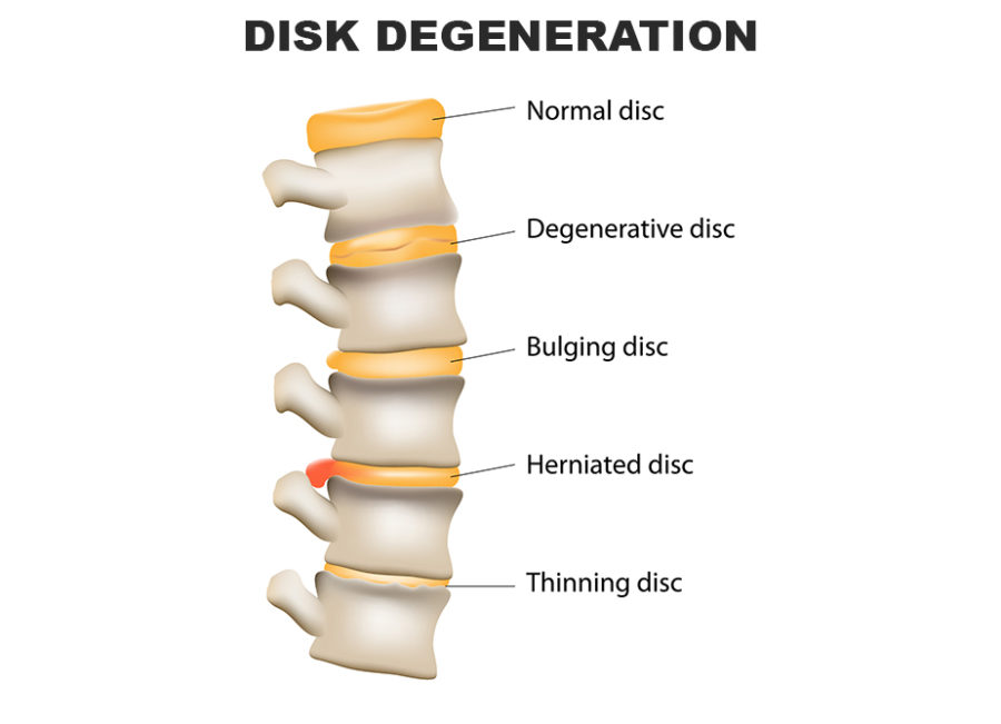 Cervical Spinal Cord Compression Direct Orthopedic Care