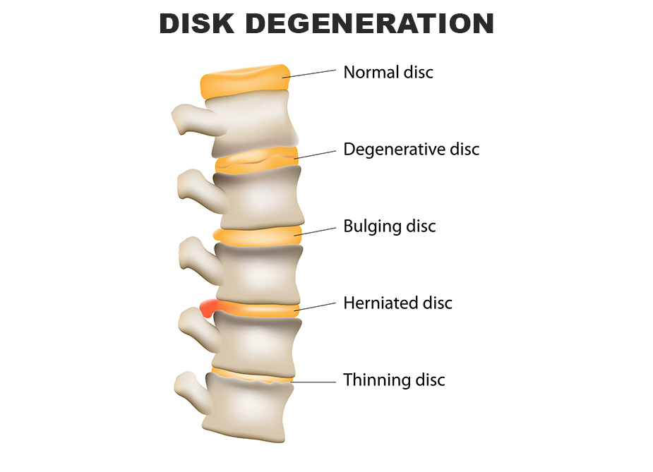 Spinal cord with normal, degenerative, bulging, herniating, and thinning disks.