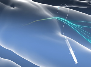 Illustration of Femoral Nerve Block