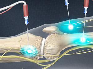 Illustration of Genicular Nerve Ablation