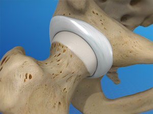 Illustration close up of the hip joint