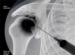 Illustration of a shoulder getting an injection to help pain