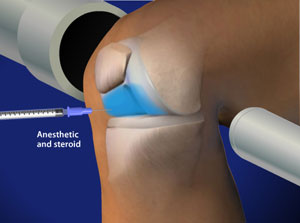 Illustration for Fluoroscopic Guided Steroid Injection for Knee Pain