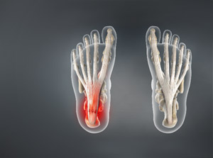 X-ray illustration of plantar fasciitis.