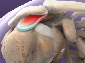 Internal view of shoulder demonstrating impinge syndrome