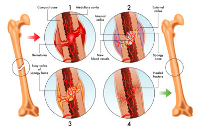 Illustration of stages of bone healing after a fracture.