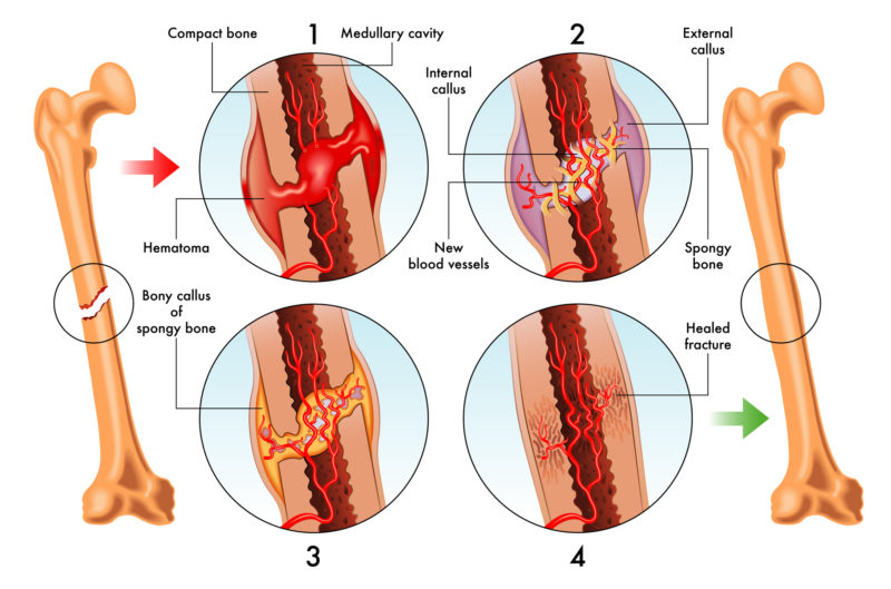 Illustration of stages of bone healing after a fracture.