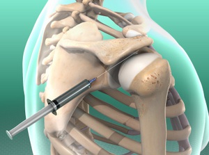 Illustration demonstrating Subacromial Injection