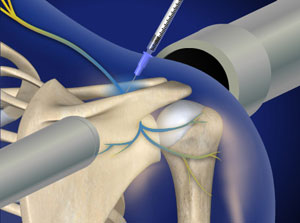 Simulated image demonstrating suprascapular nerve block