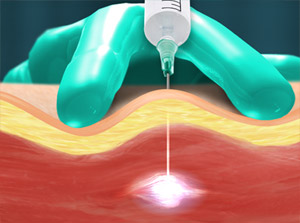 Trigger point injection illustration.