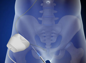 Illustration of an injection in the hip