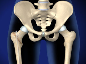 Illustration of hip bones.