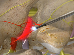 Artist's rendition of Radiofrequency Neurotomy of the Thoracic Facets procedure.