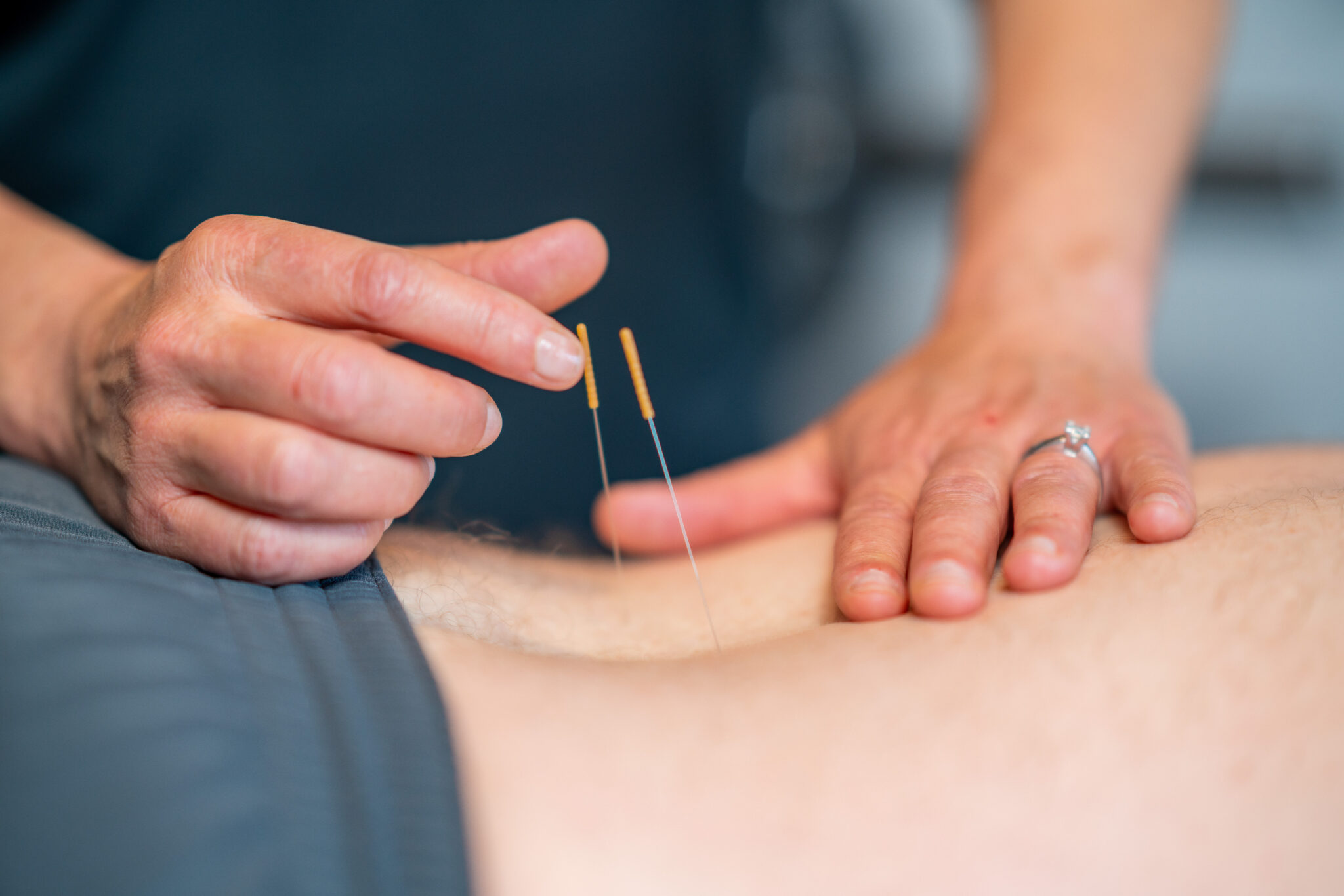 Dry Needling in Miami